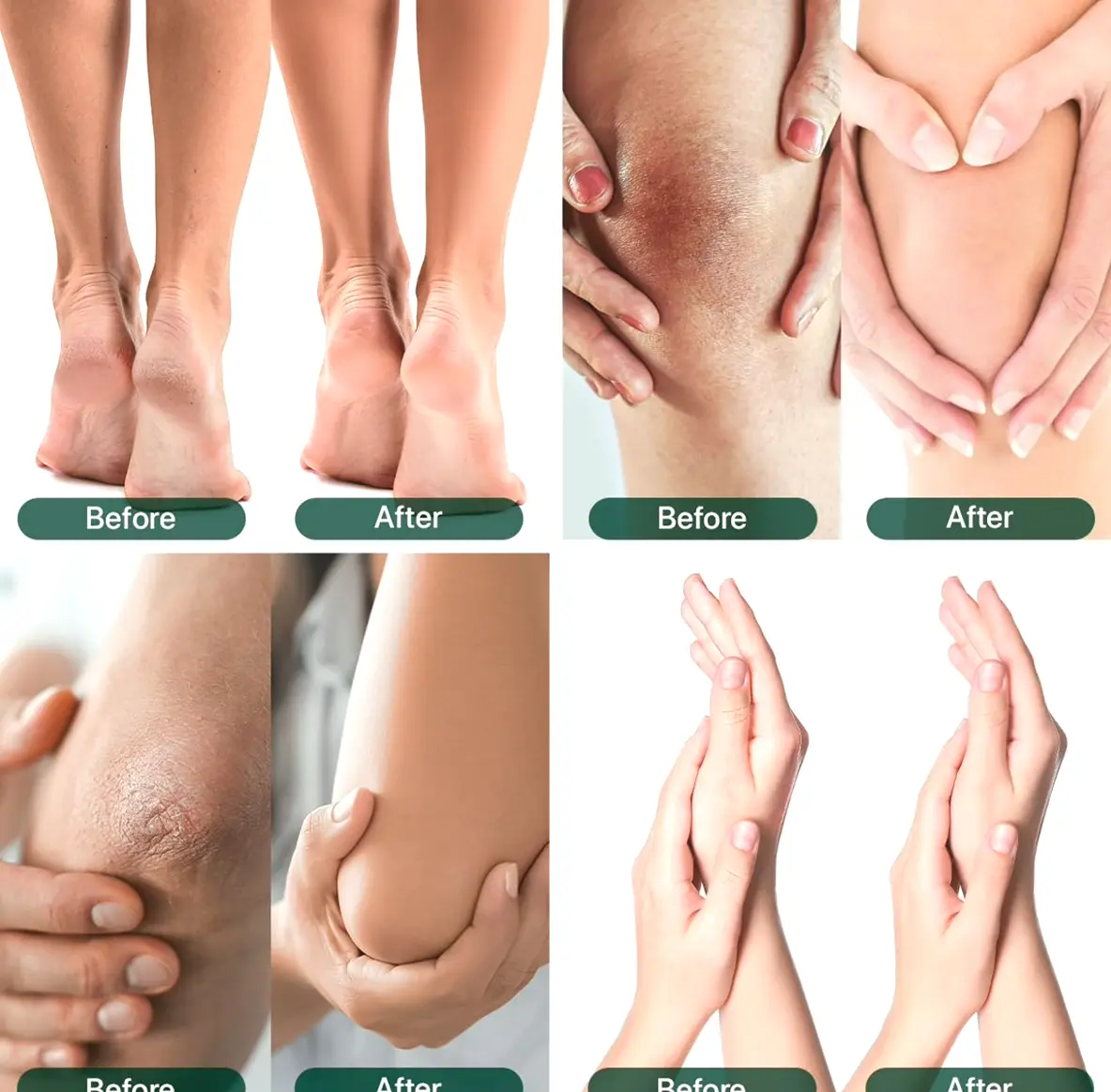 Healing Lotion 40% for Feet, Cracked Heels Treatment